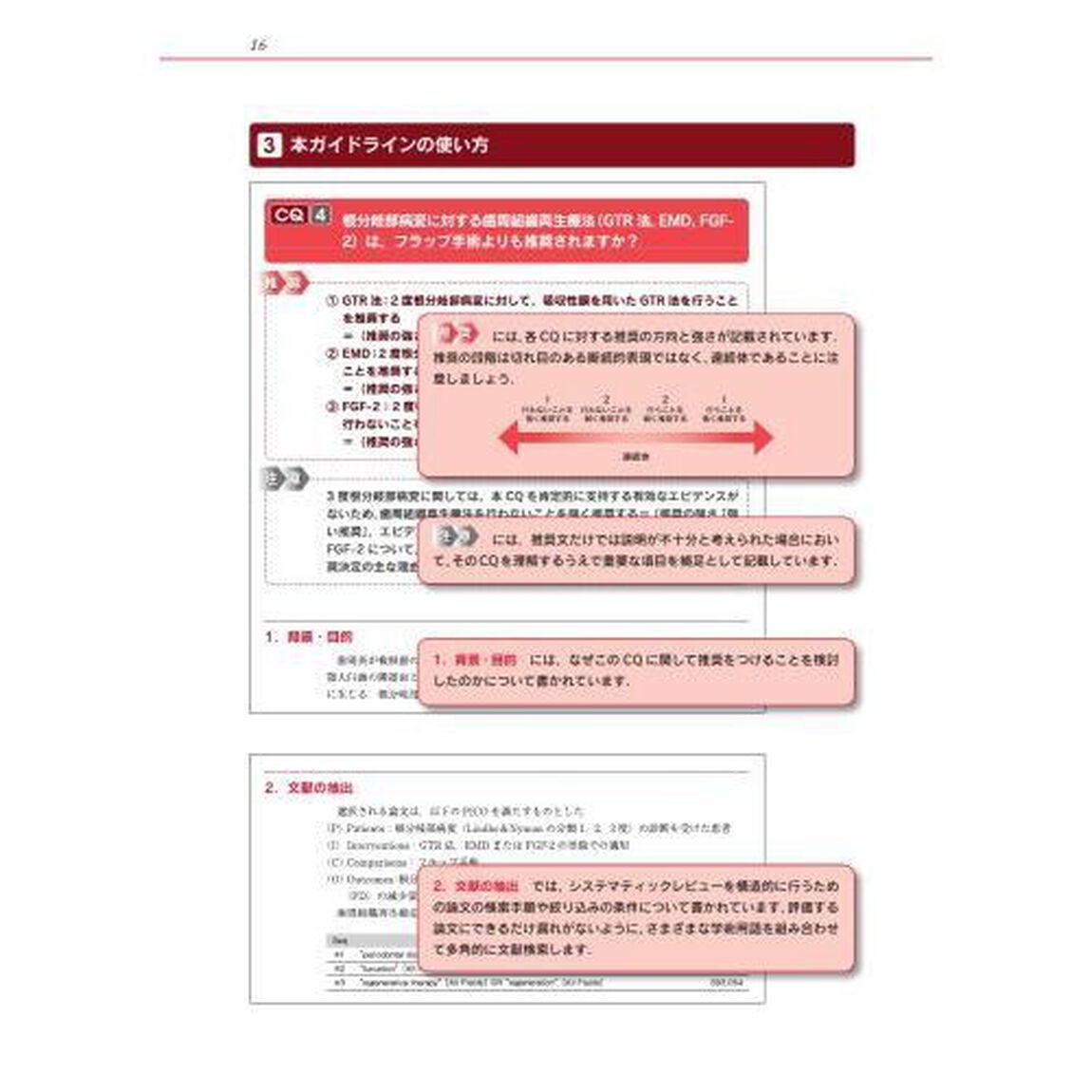 歯周病患者における再生療法のガイドライン　２０２３