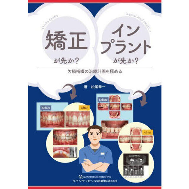 矯正が先か？インプラントが先か？　欠損補綴の治療計画を極める