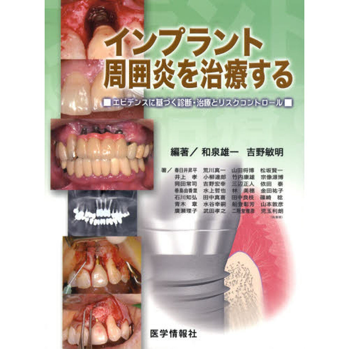 インプラント周囲炎を治療する　エビデンスに基づく診断・治療とリスクコントロール