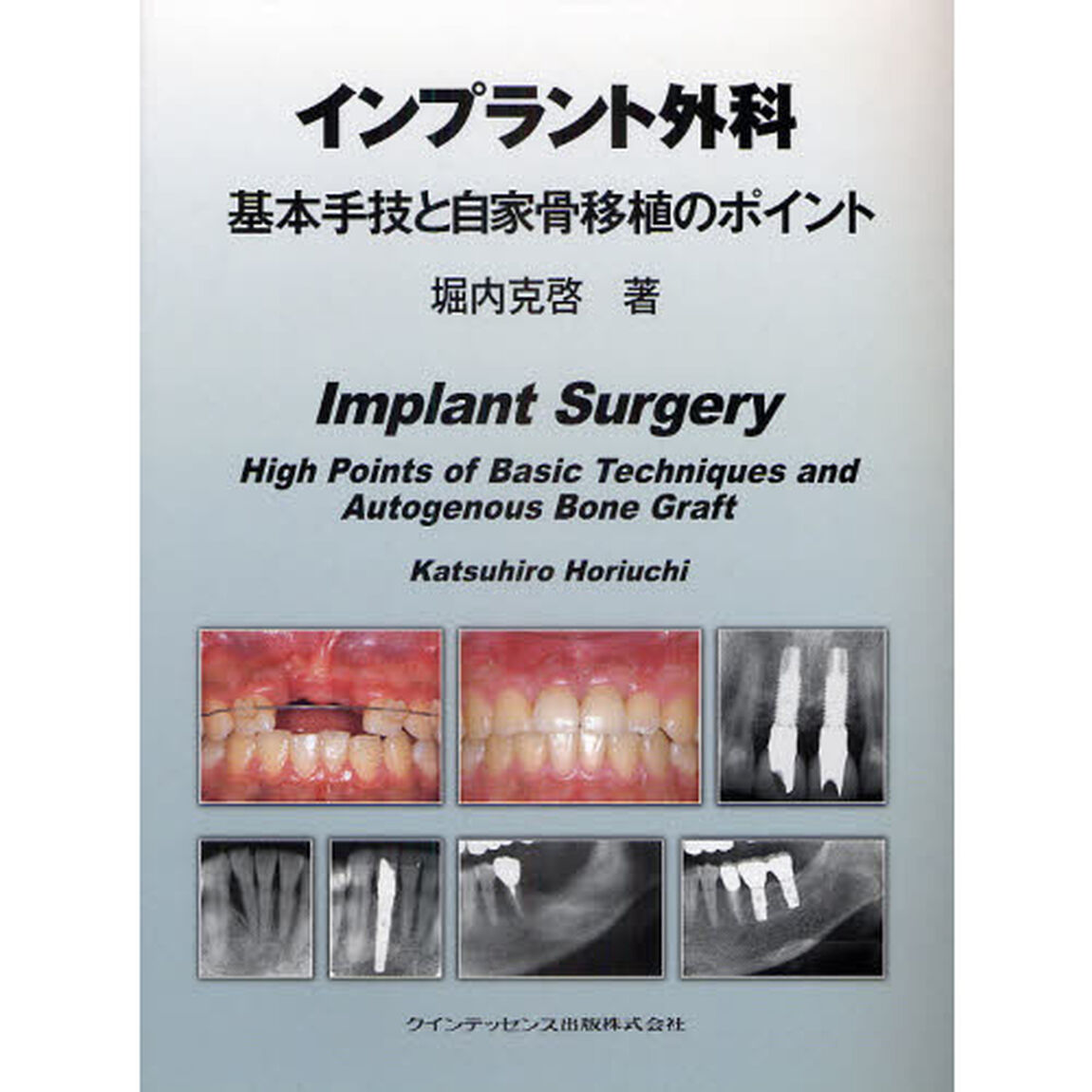 インプラント外科基本手技と自家骨移植のポイント