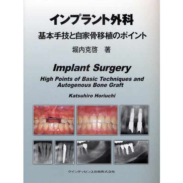 インプラント外科基本手技と自家骨移植のポイント