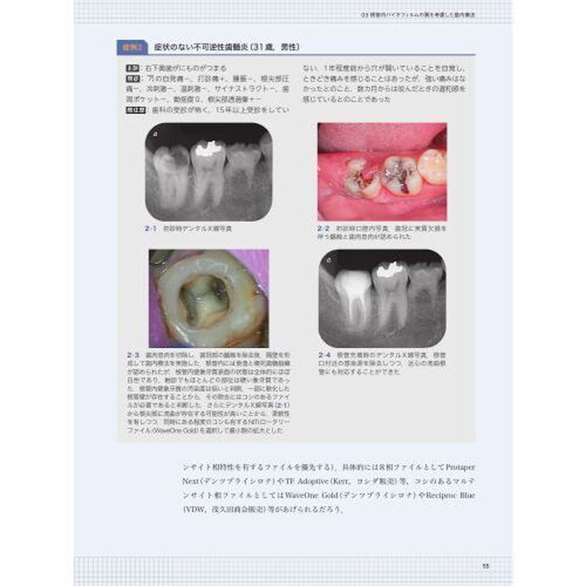 細菌学的アプローチによる歯内療法の臨床　バイオフィルム感染症として捉え解決に導く