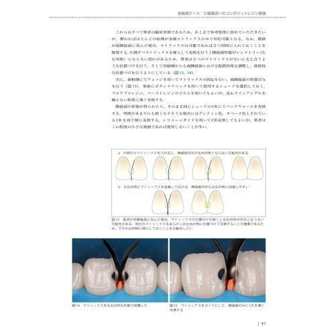 臨床に活かせるコンポジットレジン修復　レベルアップに必要なテクニックと勘所