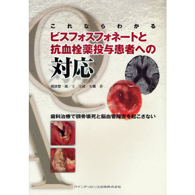 これならわかるビスフォスフォネートと抗血栓薬投与患者への対応　歯科治療で顎骨壊死と脳血管障害を起こさない