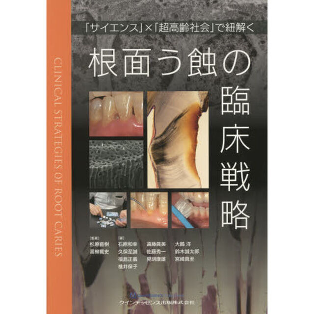 根面う蝕の臨床戦略　「サイエンス」&times;「超高齢社会」で紐解く