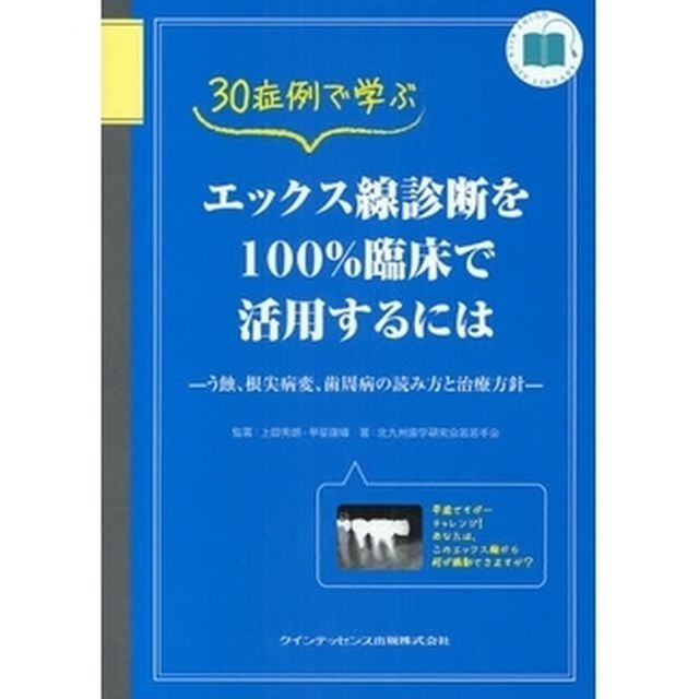 ３０症例で学ぶエックス線診断を１００％臨床で活用するには　う蝕、根尖病変、歯周病の読み方と治療方針