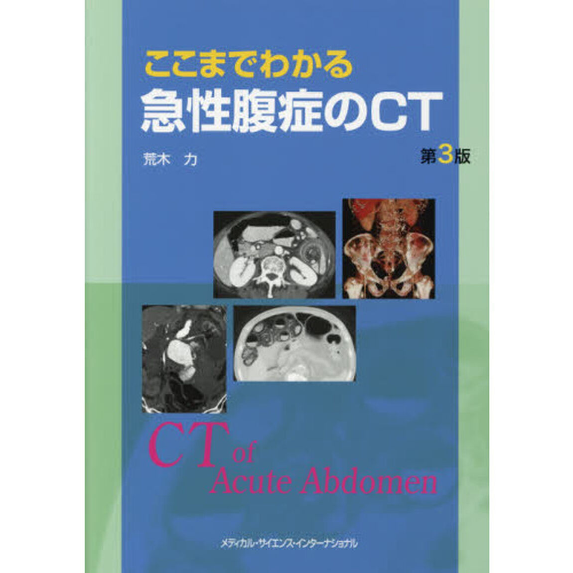 ここまでわかる急性腹症のＣＴ「第３版」