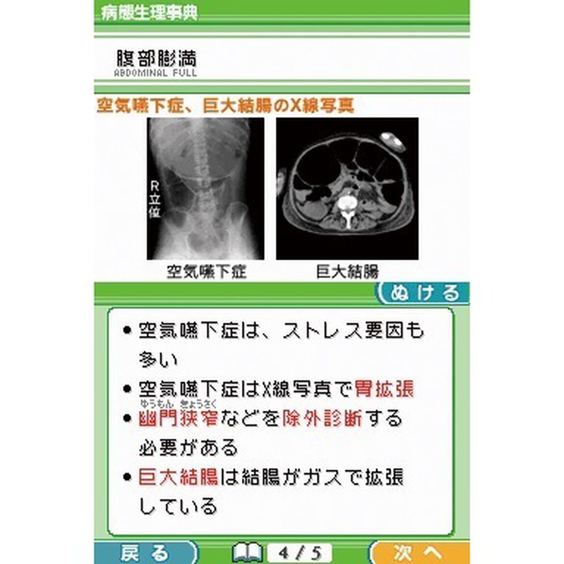 病態生理　ＤＳ