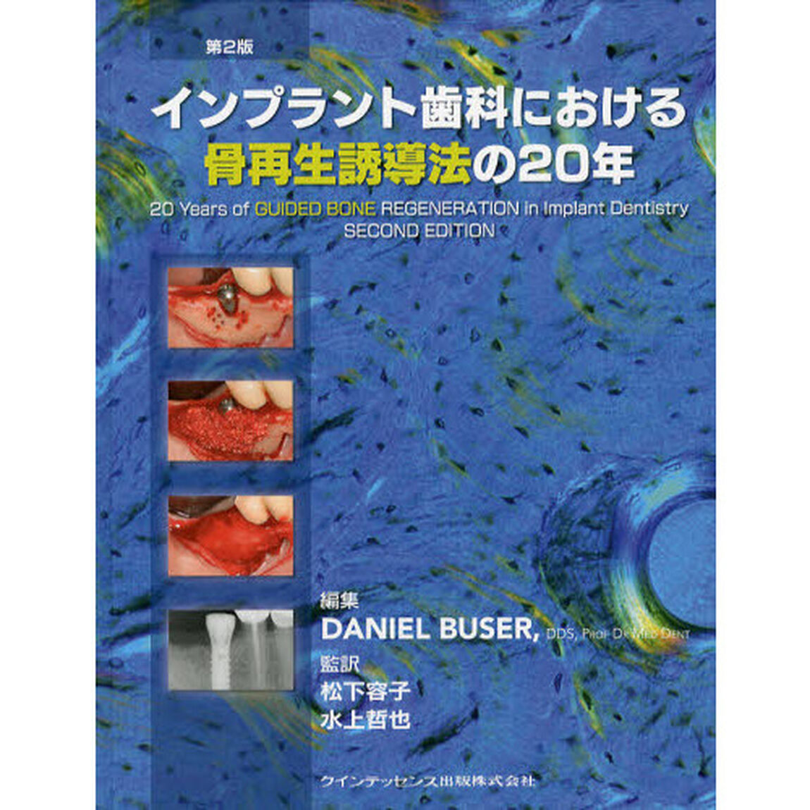 インプラント歯科における骨再生誘導法の２０年「第２版」