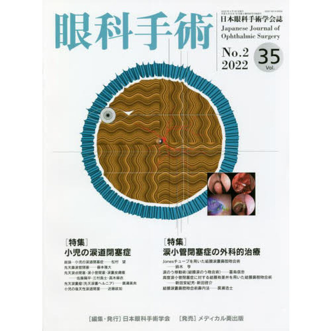 眼科手術　日本眼科手術学会誌　Ｖｏｌ．３５Ｎｏ．２（２０２２）「特集小児の涙道閉塞症／涙小管閉塞症の外科的治療」