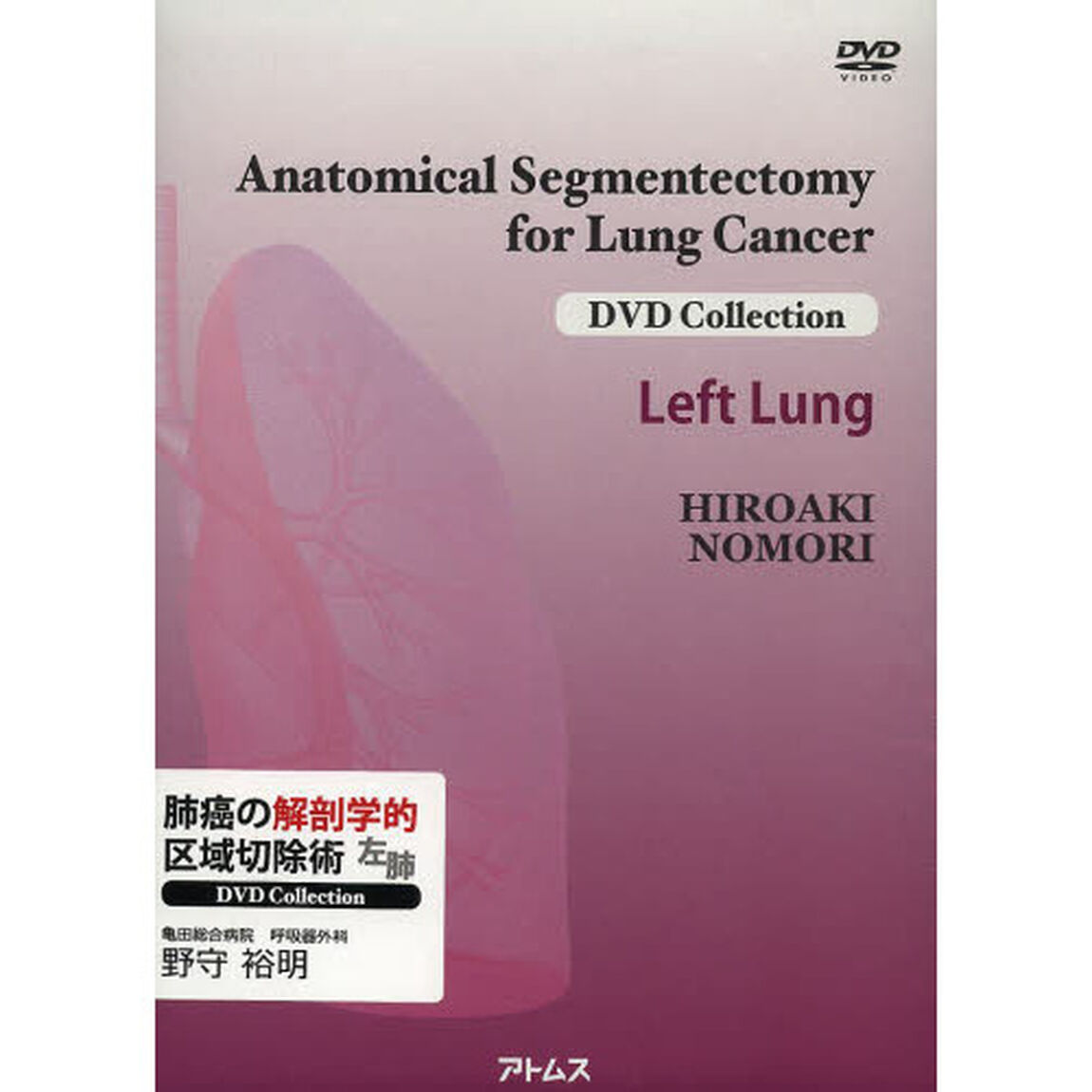 肺癌の解剖学的区域切除術　左肺　ＤＶＤ