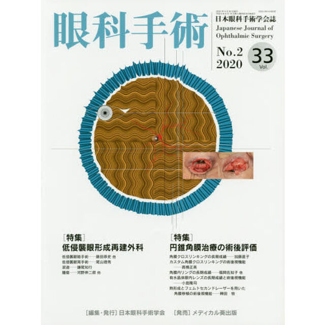 眼科手術　日本眼科手術学会誌　Ｖｏｌ．３３Ｎｏ．２（２０２０）「特集低侵襲眼形成再建外科／円錐角膜治療の術後評価」