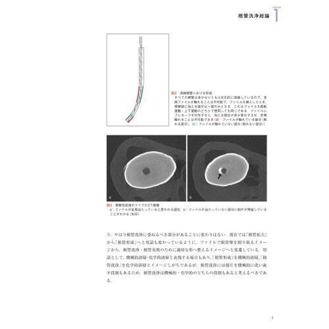 根管洗浄