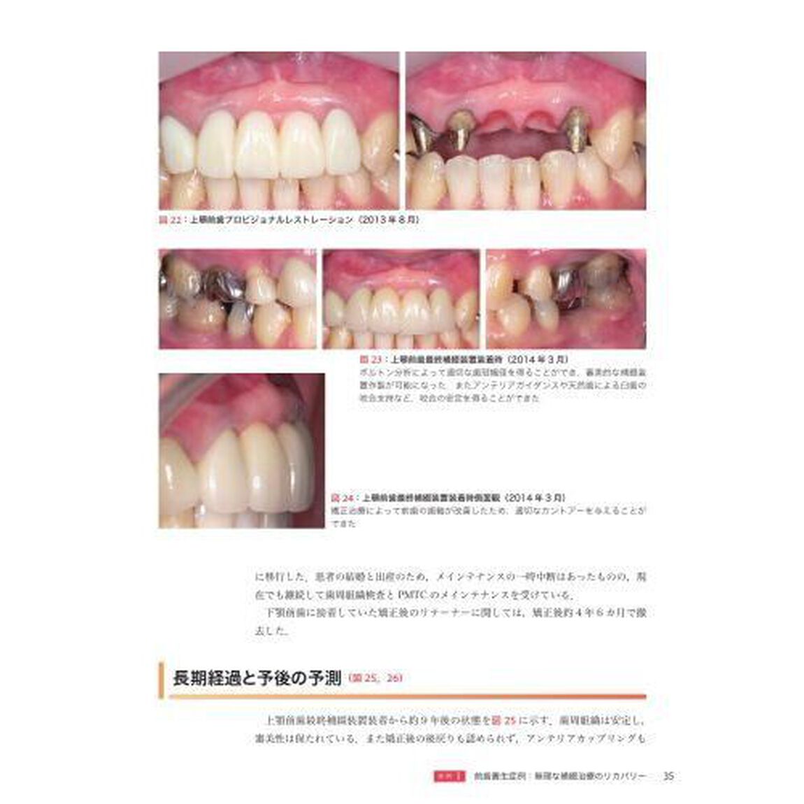 ＧＰが行う矯正治療を組み入れた咬合再構成　フローチャートでわかる治療計画立案