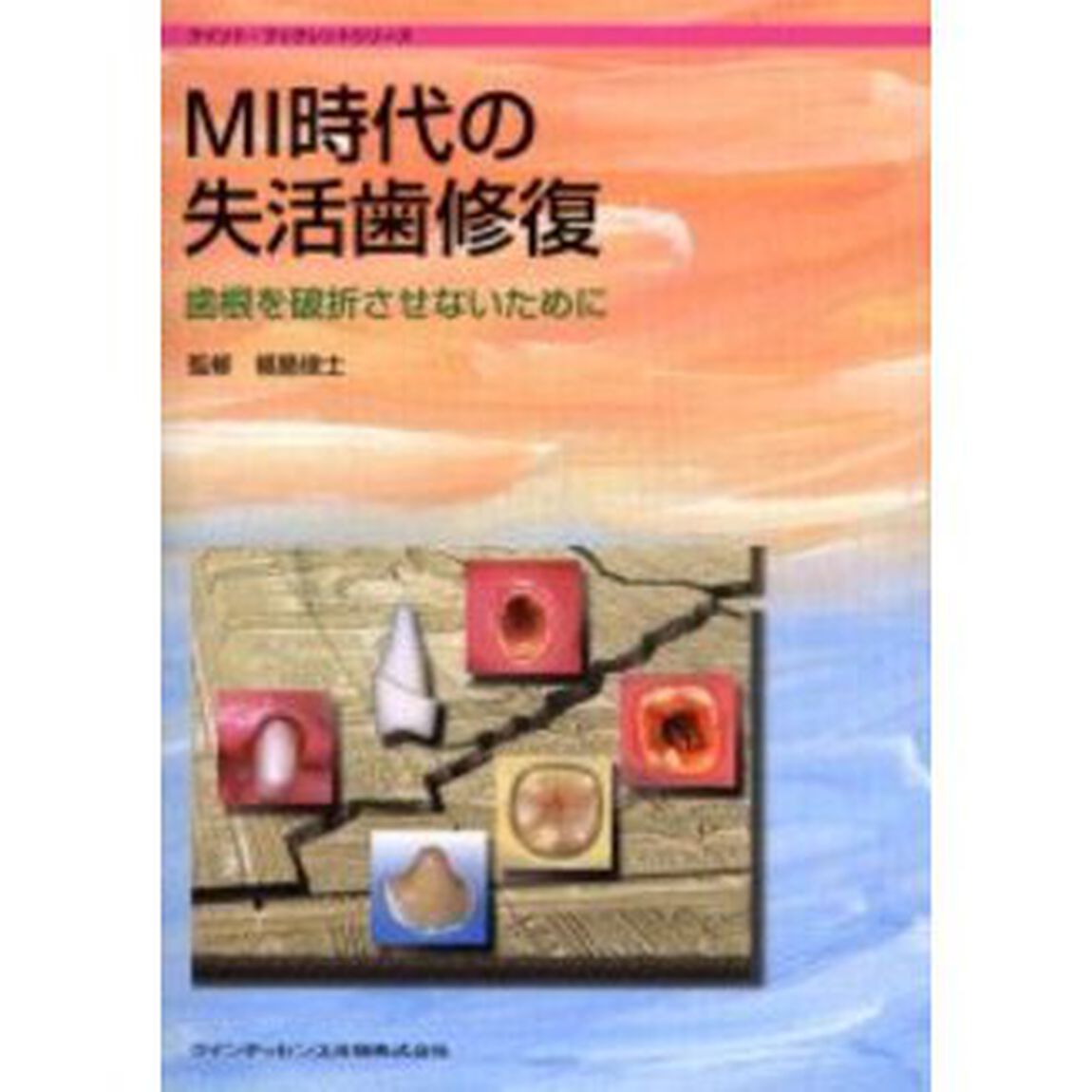 ＭＩ時代の失活歯修復　歯根を破折させないために