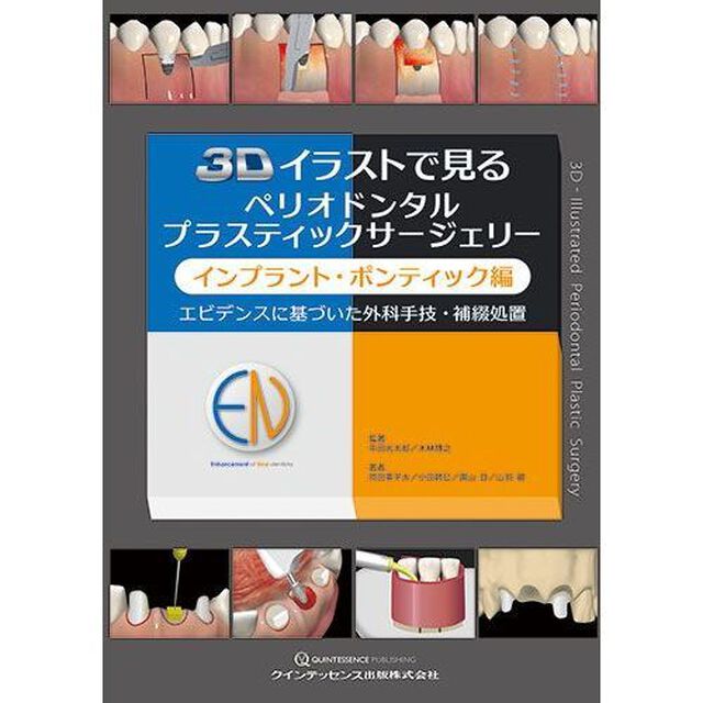 ３Ｄイラストで見るペリオドンタルプラスティックサージェリー　インプラント・ポンティック編「エビデンスに基づいた外科手技・補綴処置」