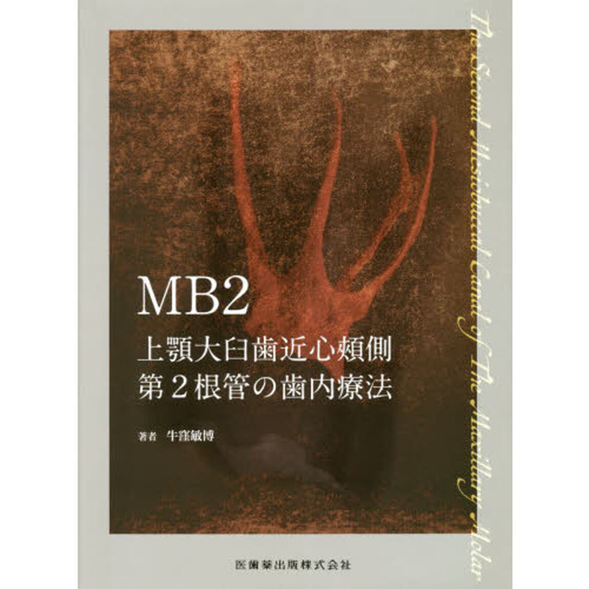 ＭＢ２上顎大臼歯近心頬側第２根管の歯内療法