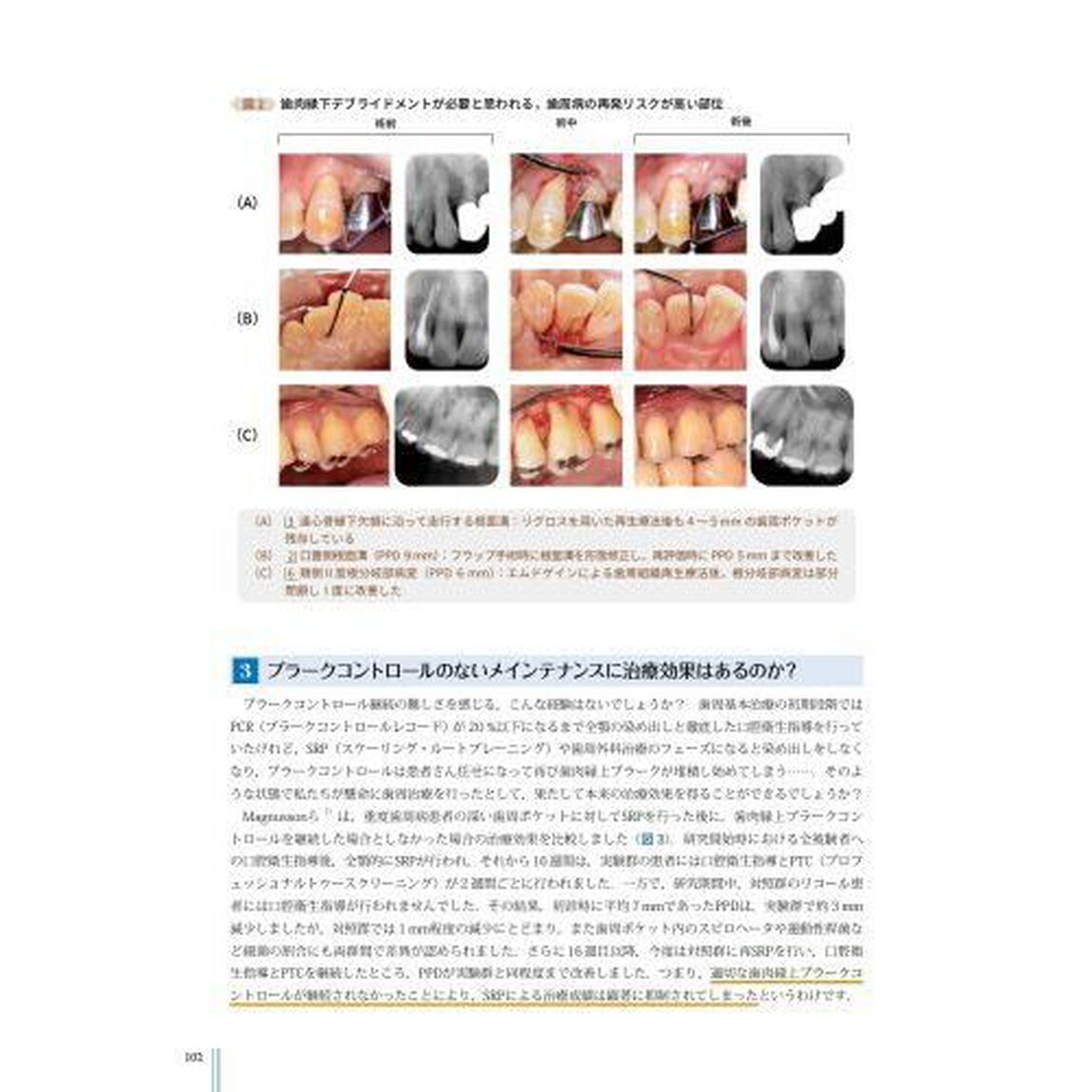 &ldquo;超音波&rdquo;を攻略せよペリオドンタル・デブライドメント　プラス１