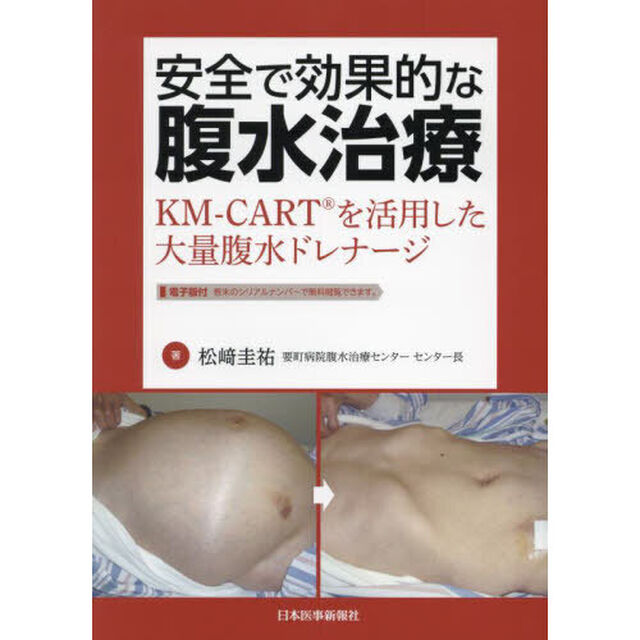 安全で効果的な腹水治療　ＫＭ－ＣＡＲＴを活用した大量腹水ドレナージ