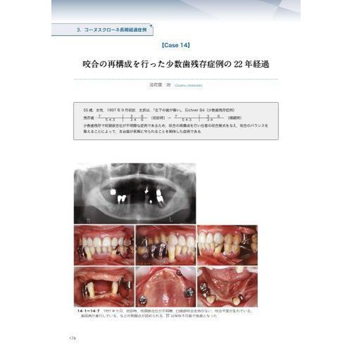 検証コーヌスクローネ　長期経過症例と臨床統計からの再評価