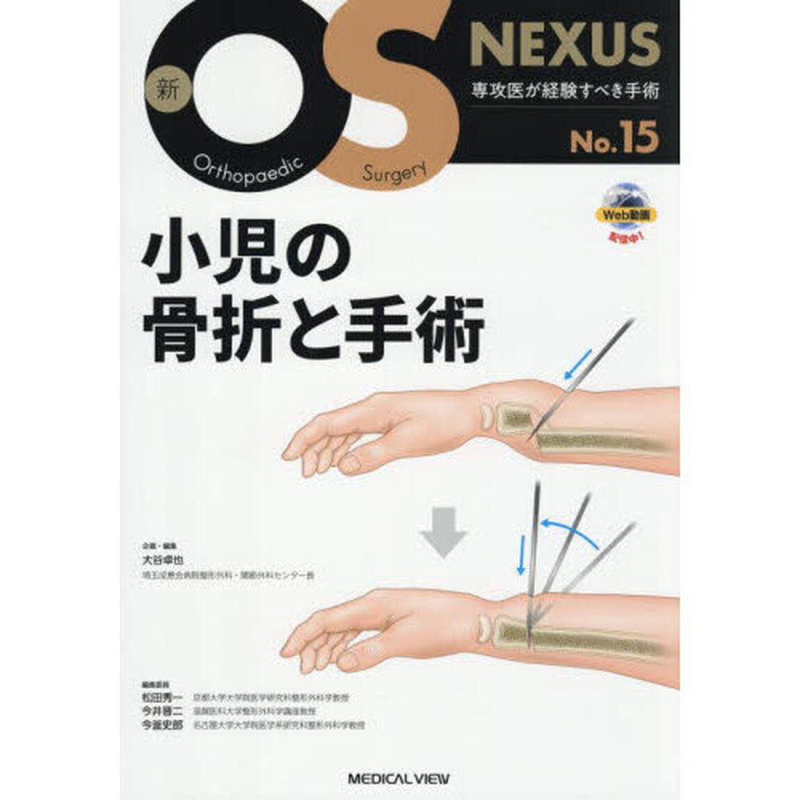小児の骨折と手術