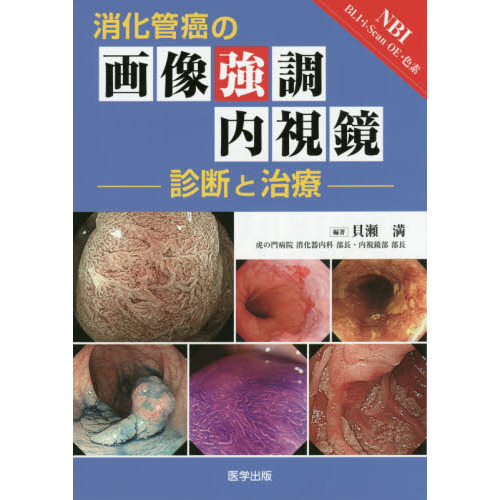 消化管癌の画像強調内視鏡　診断と治療　ＮＢＩ　ＢＬＩ・ｉ‐Ｓｃａｎ　ＯＥ・色素