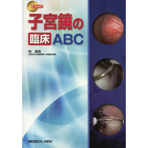 子宮鏡の臨床ＡＢＣ