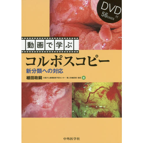 動画で学ぶコルポスコピー　新分類への対応